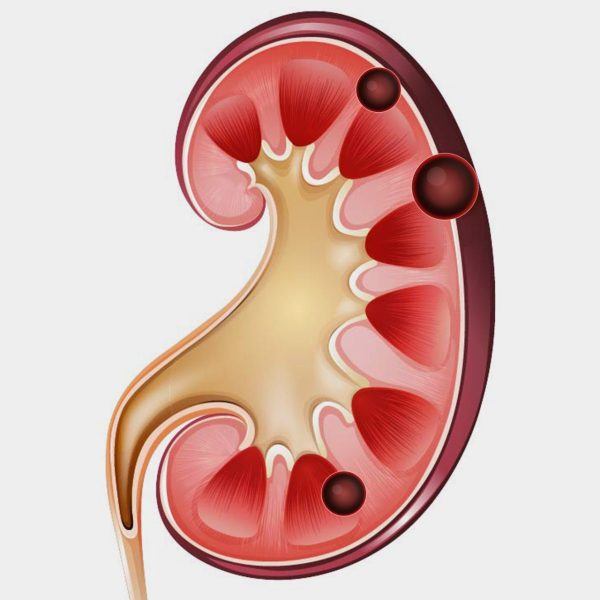 Cisto Renal Cisto Renal