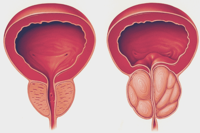 Hiperplasia Benigna da Próstata (HPB): Sintomas, Diagnóstico e Tratamento com Apoio da UROSERV