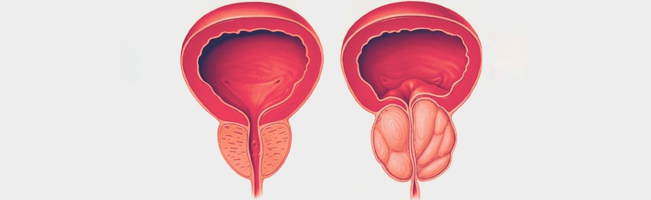 Hiperplasia-Benigna-da-Prostata-1