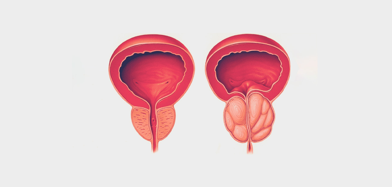 Hiperplasia-Benigna-da-Prostata-1