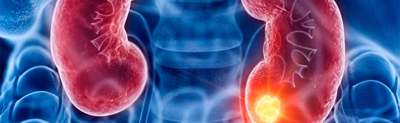 cancer-de-rim-2 cancer-de-rim-2