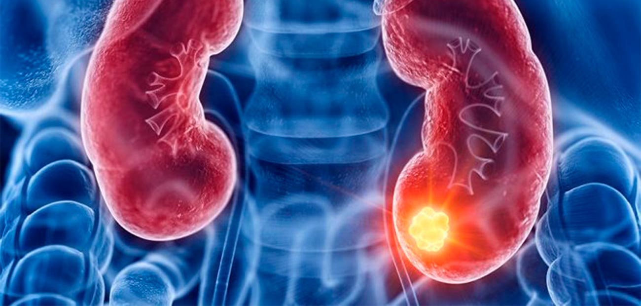 cancer-de-rim-2 cancer-de-rim-2