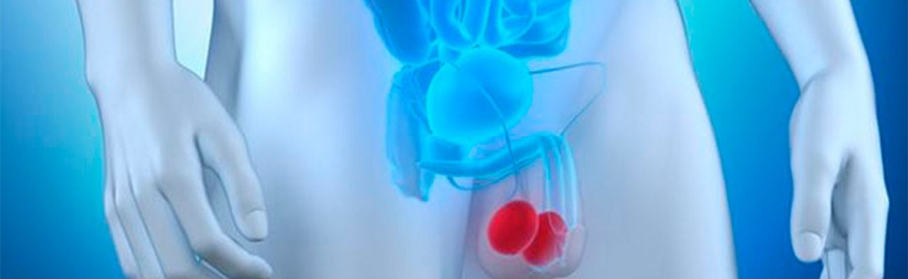 cancer-de-testiculo cancer-de-testiculo