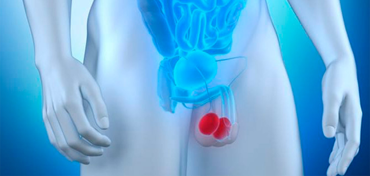 cancer-de-testiculo cancer-de-testiculo