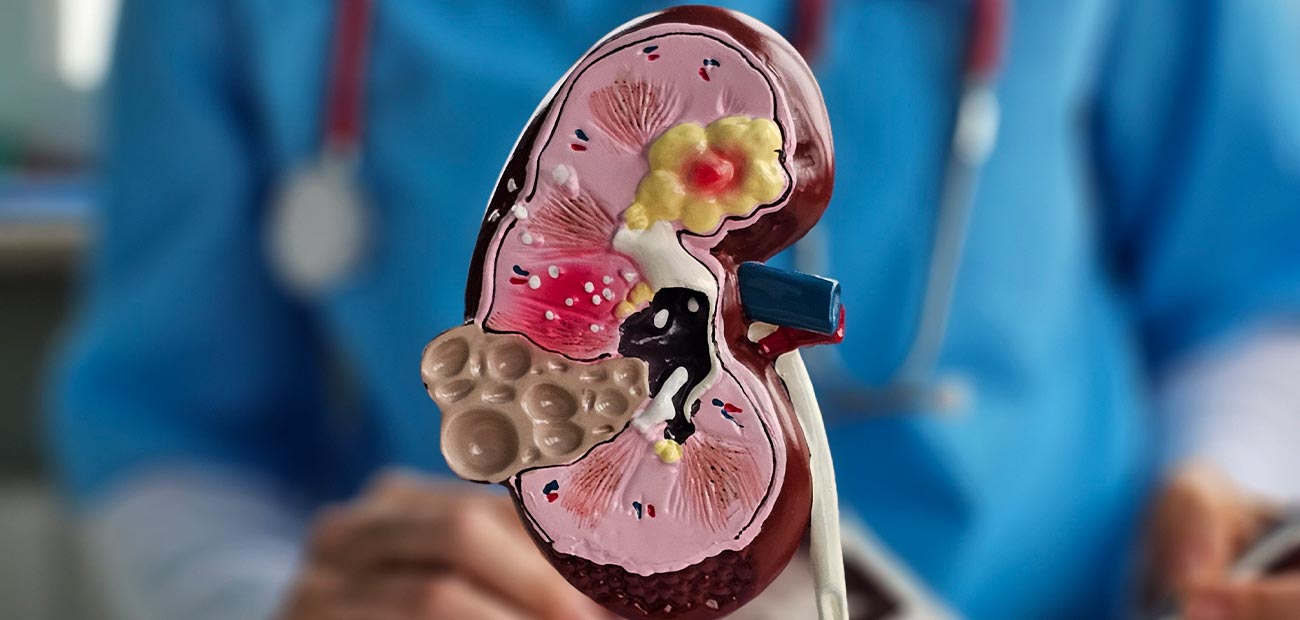 cisto-renal-1 cisto-renal-1