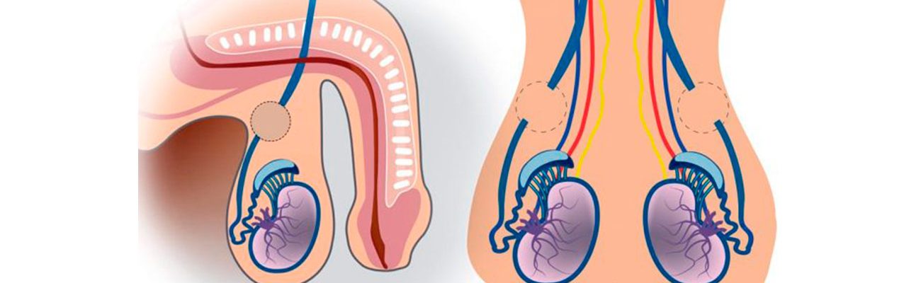 infertilidade-e-vasectomia infertilidade-e-vasectomia