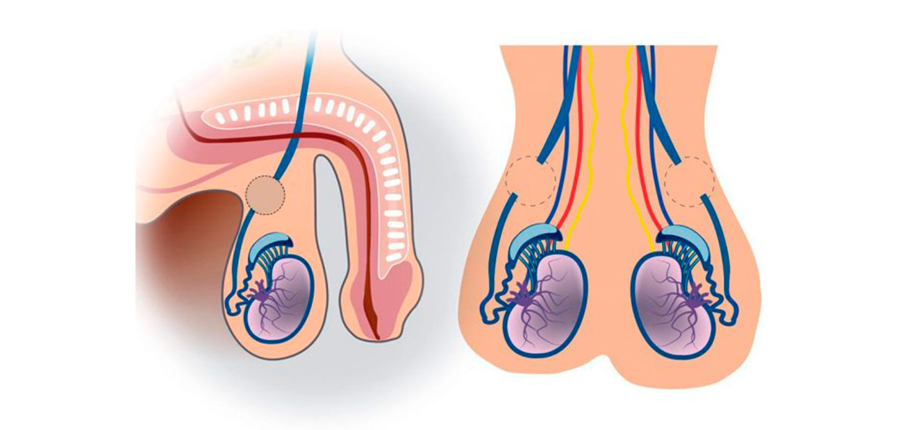 infertilidade-e-vasectomia infertilidade-e-vasectomia