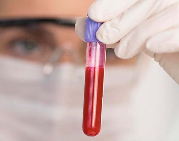 sangue-na-urina-e-no-esperma-hematospermia