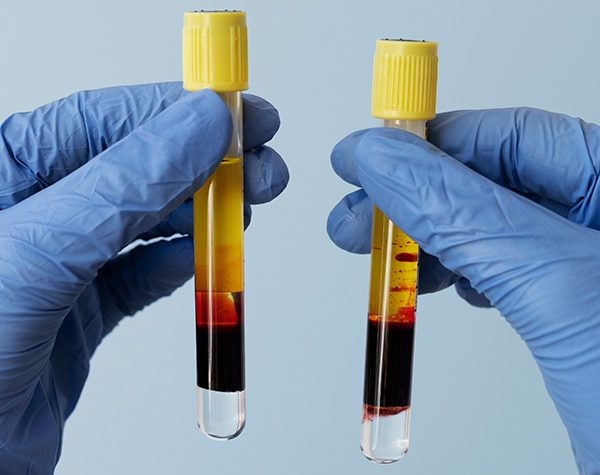 sangue-na-urina-e-no-esperma-hematuria