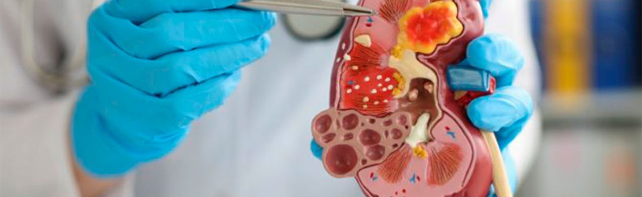 tumores-urologicos tumores-urologicos